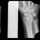 Fracture of scaphoid bone, decalcination of the fracture line, three weeks after trauma: X-ray - Plain radiograph
